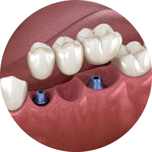 dental implant bridge model