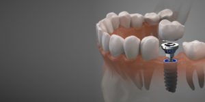 dental implant example.