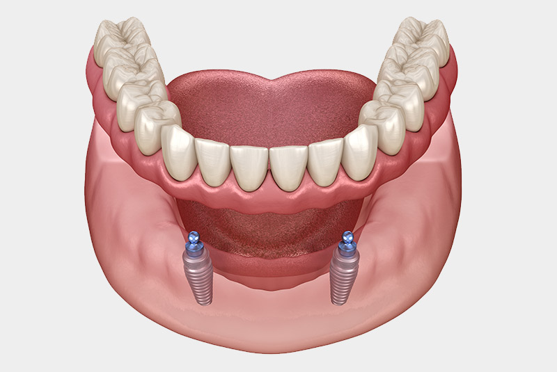 Implant supported dentures example model