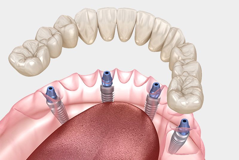 Full mouth dental implant example model