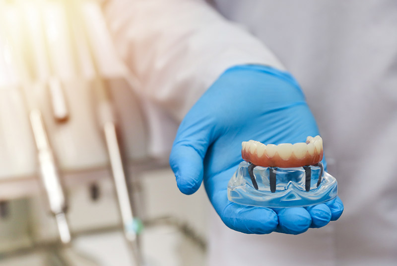 Doctor wearing blue glove holding out showing full mouth dental implants