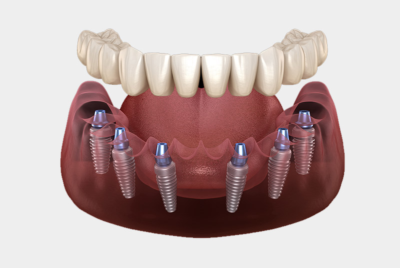 Full mouth dental implant example model