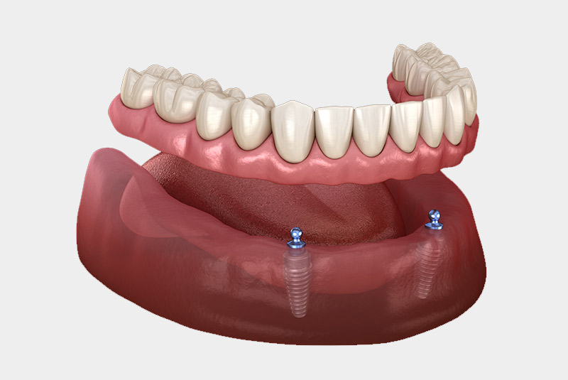 Implant supported dentures example model