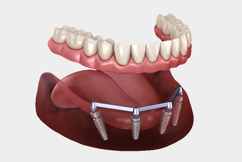 Implant supported dentures example model