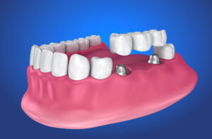 Model of oral cavity with teeth and dentist tools on color background
