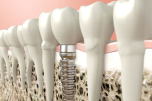 dental implant image.