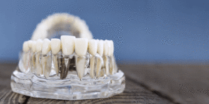 Learn how front tooth implants restore your smile, enhance functionality, and provide a lasting, natural-looking solution.