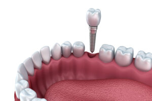 dental implants