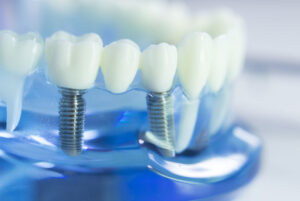 dental implants model.