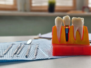 Dental implant, artificial tooth roots into jaw, root canal of dental treatment, gum disease, teeth model for dentist.