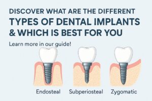 An infographic detailing the different types of dental implants, including endosteal, subperiosteal, zygomatic, and mini dental implants, each with a short description and a visual representation of how they are placed in the jaw. Text on the image says "Different Types of Dental Implants"