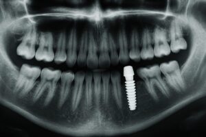 Close up x-ray of a jaw bone with a single dental implant in place. No text on the image.