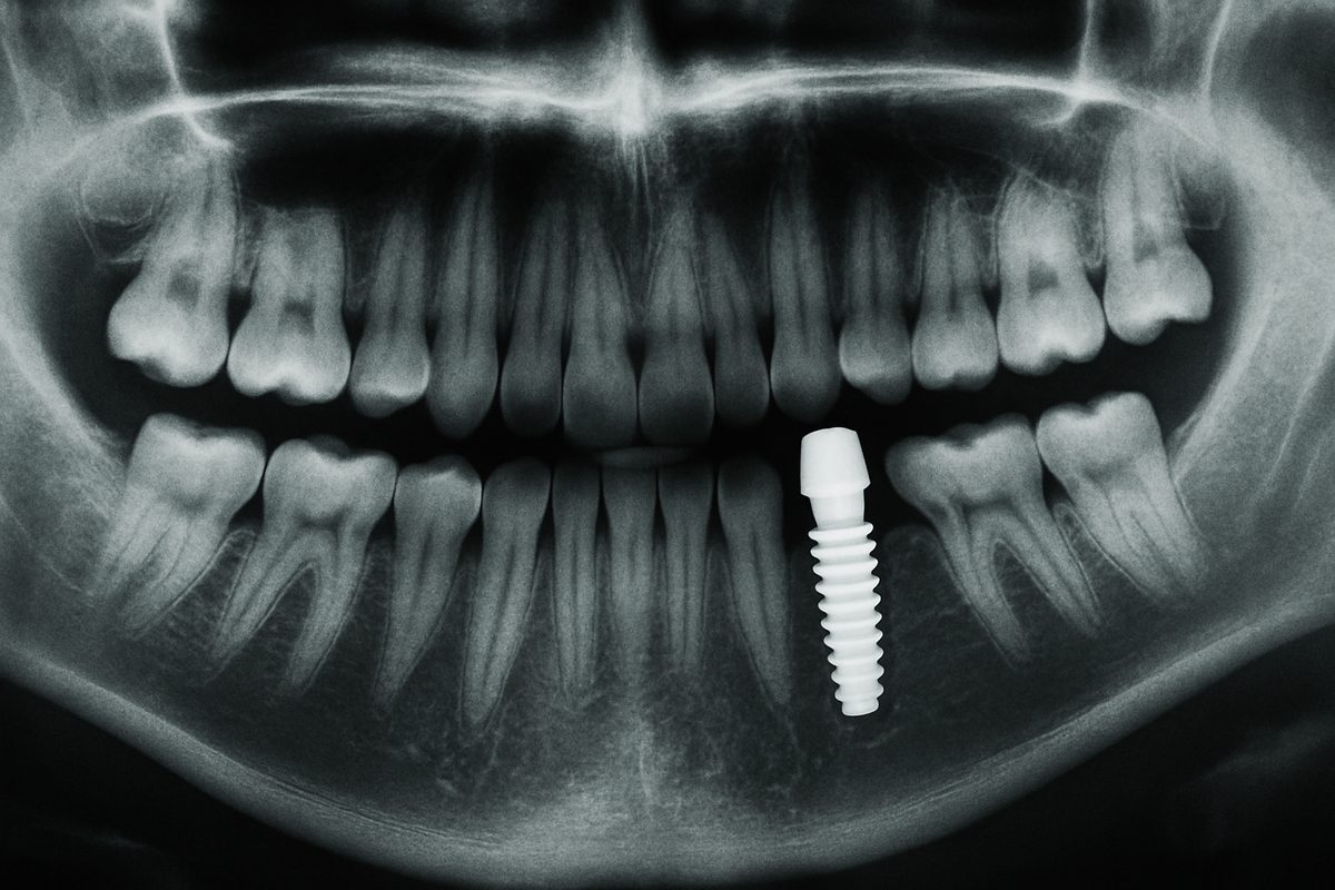* Single Dental Implant: Cost, Procedure, and Benefits in Central Tennessee