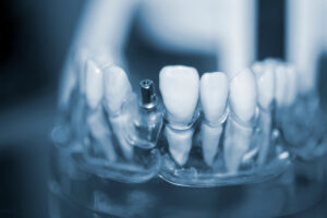 model of a dental implant with a blurry background