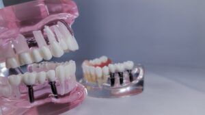 all on 4 dental implants model, full mouth implants, grey table