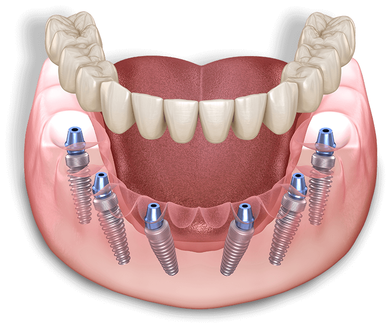 Full arch dental Implant from Golden Oak Sedation Dental & Implant Center